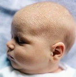Traitement Croûte De Lait (chapeau) Pour Bébé *Mini brosse | GOMMEE